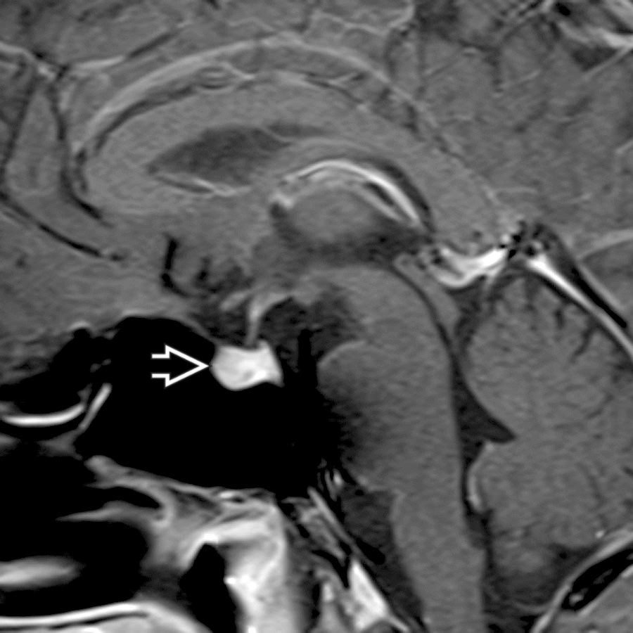 Sagittal T1 C+ MR shows a prominent pituitary gland  in a 37-year-old man with panhypopituitarism during treatment with ipilimumab for metastatic melanoma. The gland had doubled in size since MR 6 weeks prior. This drug-induced LH was related to a cancer immunotherapy.