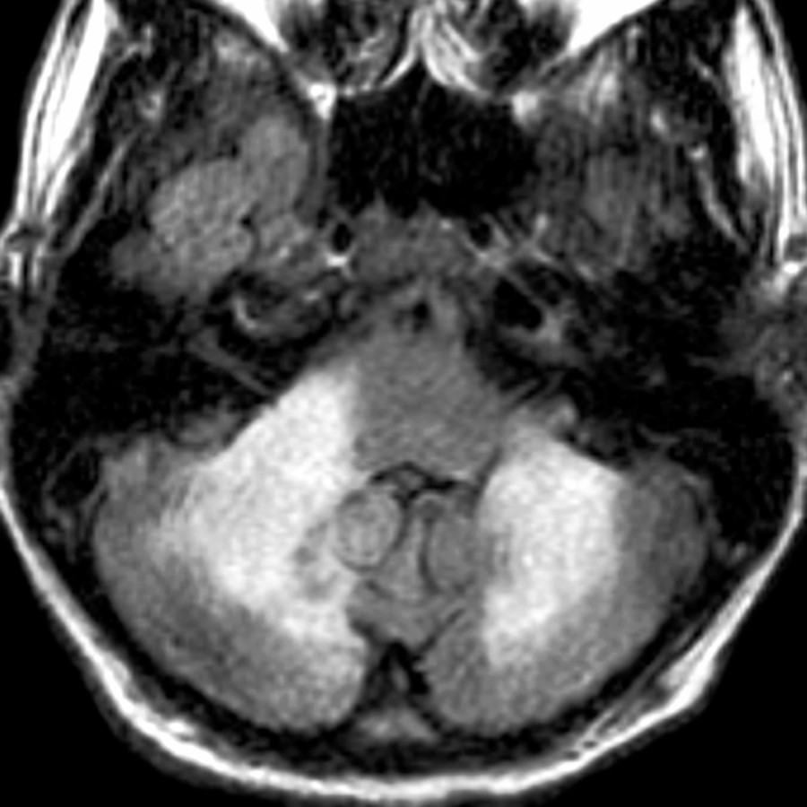 Axial FLAIR MR shows asymmetric, flocculent, nearly confluent, hyperintense lesions of acute disseminated encephalomyelitis within posterior fossa structures.