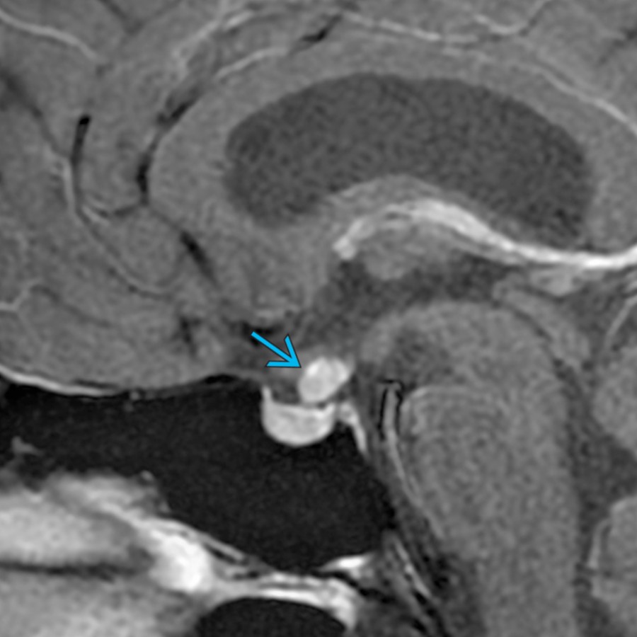 Sagittal T1 C+ MR in a 36-year-old woman with diabetes insipidus shows marked thickening and enhancement of the pituitary stalk  related to autoimmune LH. Absence of the posterior pituitary bright spot was also present.