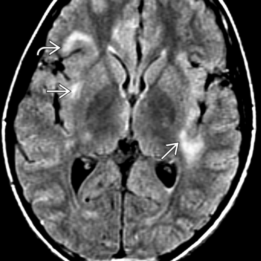 Axial FLAIR MR shows typical findings of ADEM with peripheral, subcortical hyperintense foci . Bilateral insular involvement is seen . Periventricular and callososeptal lesions, which are typical of multiple sclerosis, are not commonly seen in ADEM.
