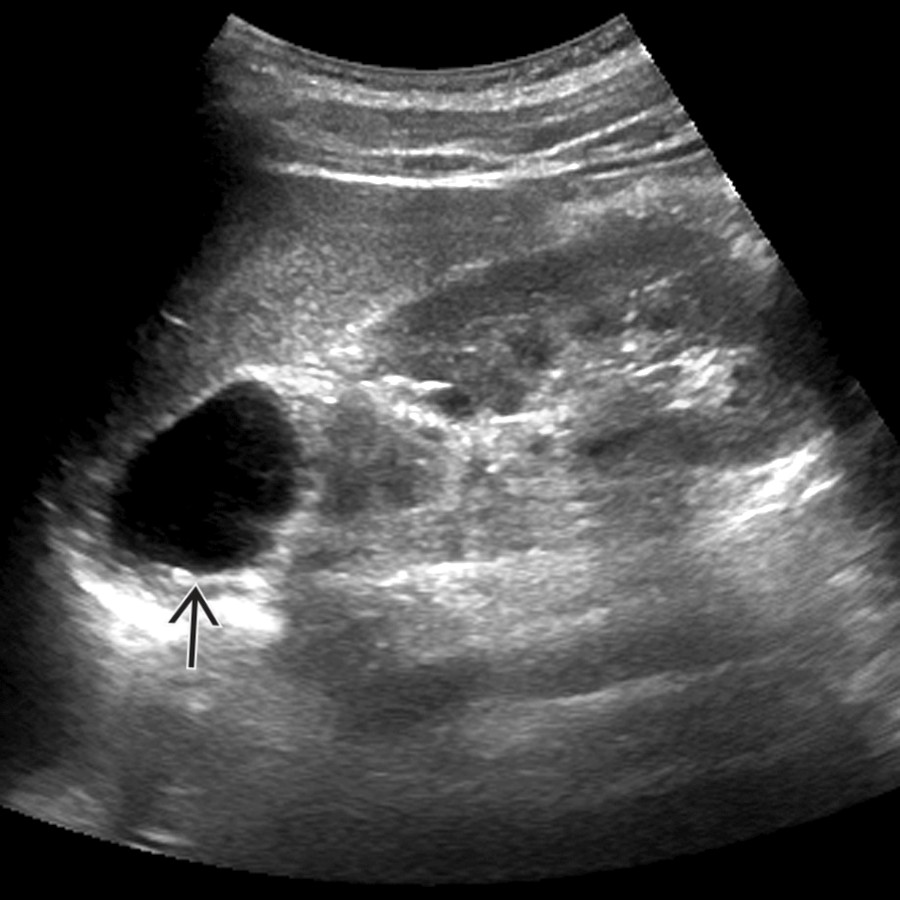 Longitudinal US in the same patient confirms an anechoic left suprarenal-adrenal cyst . The simple appearance of the cyst and the lack of additional relevant clinical history (malignancy, HTN, etc.) prompted surveillance rather than resection for this incidental, benign endothelial cyst.