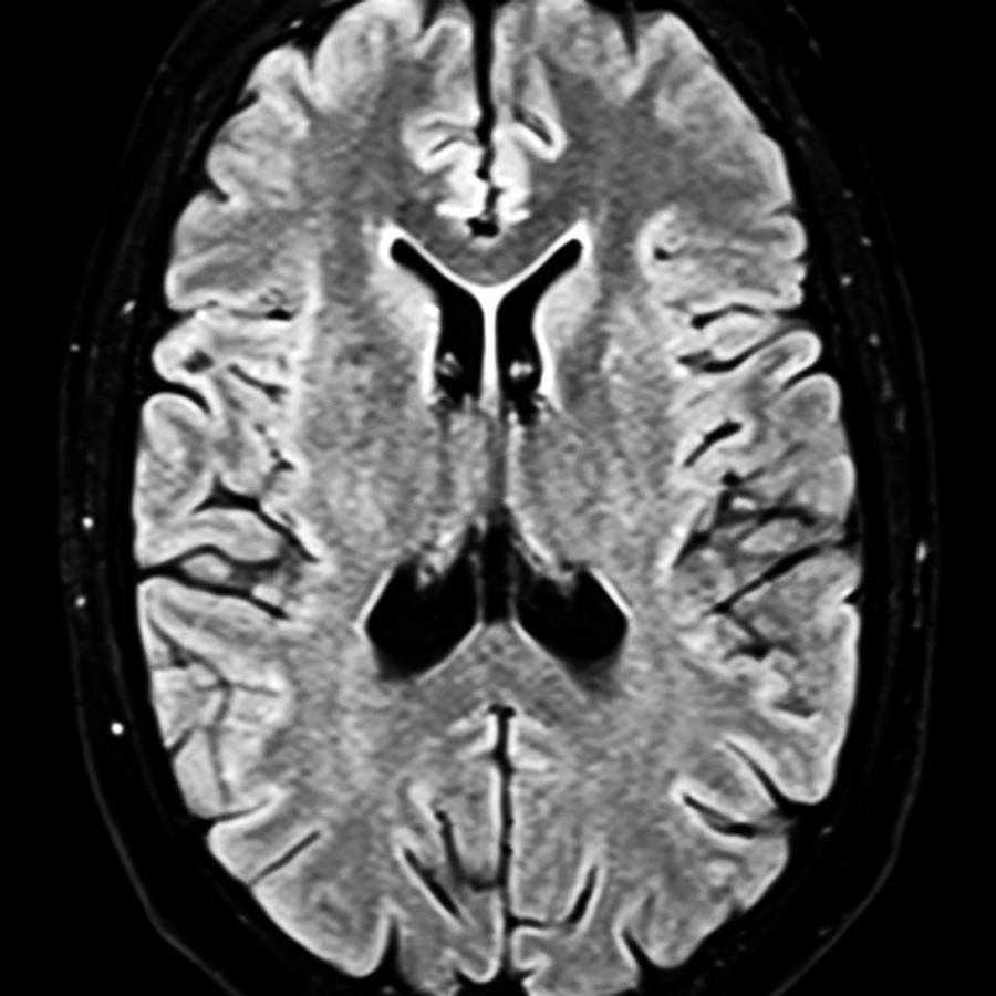 Axial FLAIR MR in a 25-year-old man with fever and rapidly decreasing mental status shows no definite abnormalities.