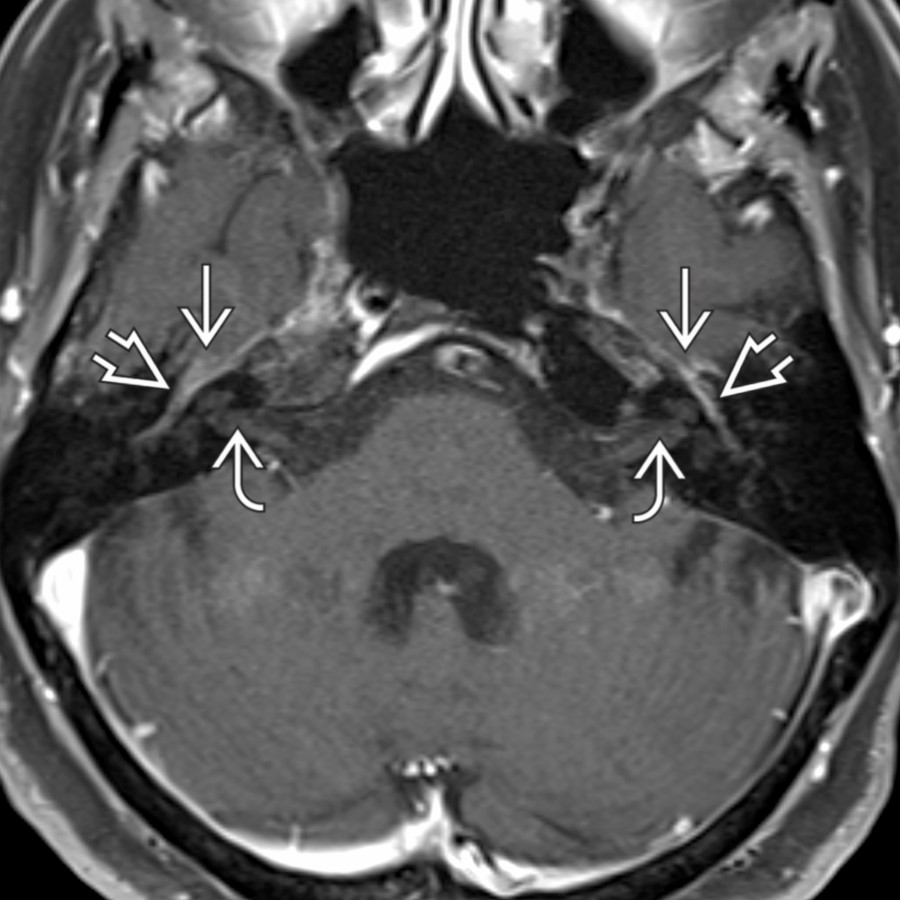 Axial T1 C+ FS MR shows the normal enhancement pattern of the facial nerves. Note mild symmetric enhancement of the geniculate ganglia  and anterior tympanic segments  but absent enhancement of the intracanalicular segments  bilaterally.