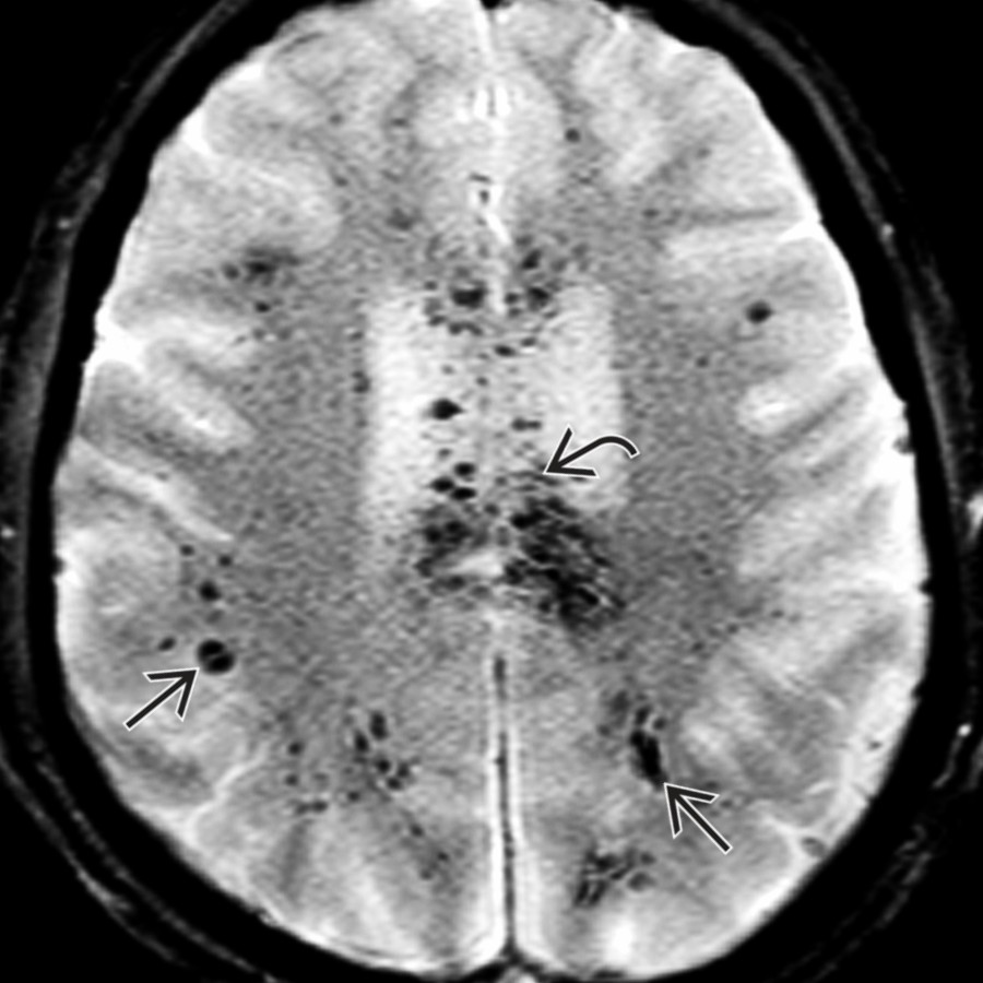 Axial T2* GRE MR in the same patient shows multiple tiny hypointensities in the corpus callosum  and deep/subcortical WM  . The cortex is largely spared.