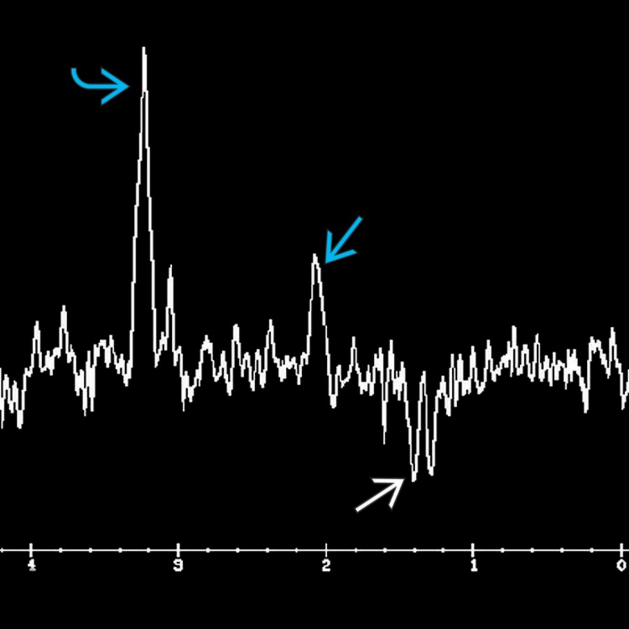 MRS at long TE in a patient with acute lesions in ADEM demonstrates ↑ choline , ↓ NAA , and the presence of a lactate doublet . Increase in choline with corresponding reductions in NAA normalize as the clinical and conventional neuroimaging abnormalities resolve.