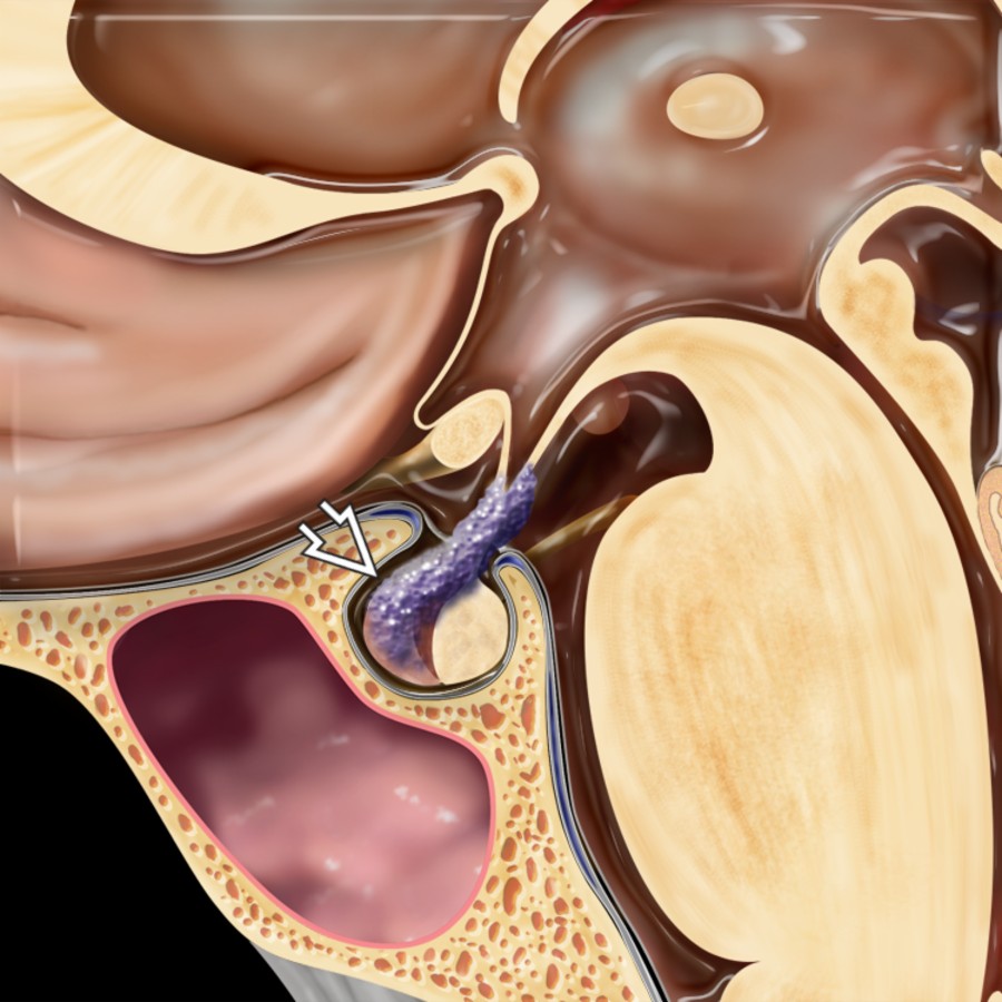 Sagittal graphic shows lymphocytic hypophysitis (LH). Note thickening of the infundibulum with loss of the normal "top to bottom" tapering as well as infiltration into the anterior lobe of the pituitary gland .