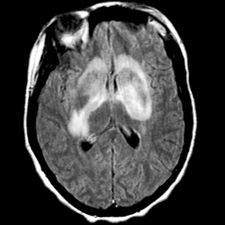 Axial FLAIR MR demonstrates a rare manifestation of ADEM: Bilateral striatal necrosis, evidenced by asymmetric confluent hyperintensity involving the gray and white matter of bilateral corpus striatum.