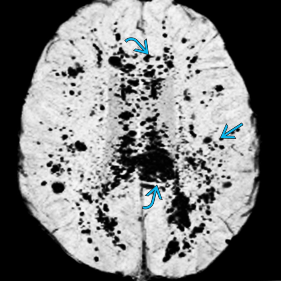 Axial T2* SWI MR MIP shows the innumerable microbleeds in the corpus callosum    with diffuse involvement of the hemispheric WM    in this patient with AHLE.