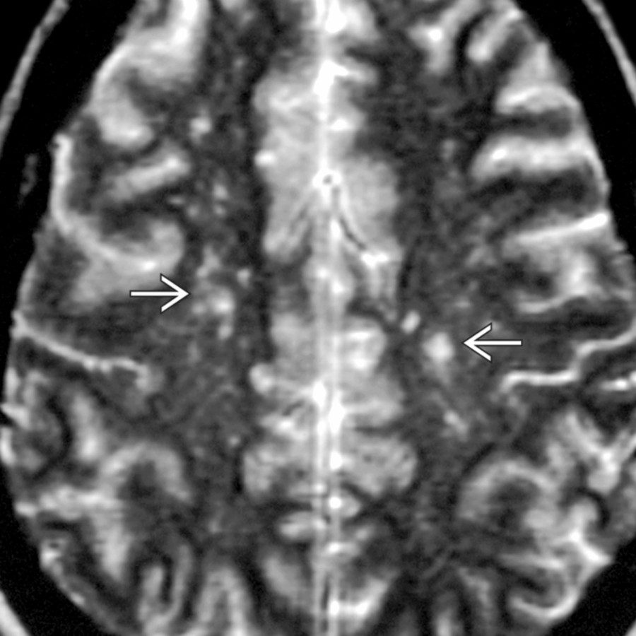 Axial T2 MR shows multiple bilateral, but asymmetric, T2-hyperintense foci . None of the lesions demonstrate significant mass effect in this adult patient with ADEM. Imaging mimics multiple sclerosis, vasculitis, and microvascular ischemia.