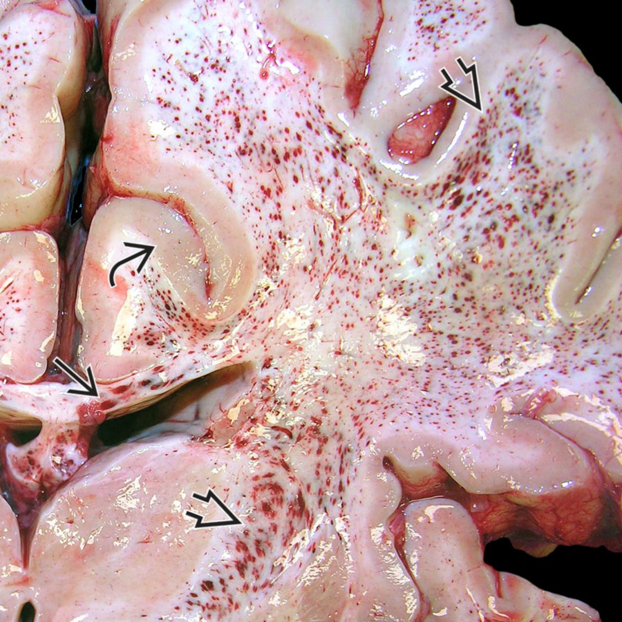 Close-up view of autopsied brain in a patient with acute hemorrhagic leukoencephalitis (AHLE) shows innumerable tiny microbleeds in the subcortical and deep white matter (WM)   and corpus callosum . Note the overlying cortex is almost completely spared . (Courtesy E. Rushing, MD.)