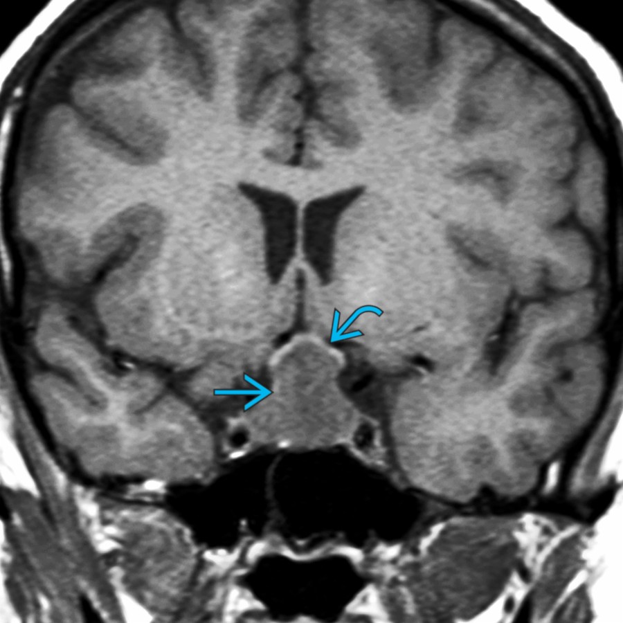 Coronal T1 MR in a 19-year-old pregnant woman who developed onset of vision problems in the late 3rd trimester shows a large "figure of 8," intra- and suprasellar mass  that elevates the optic chiasm .