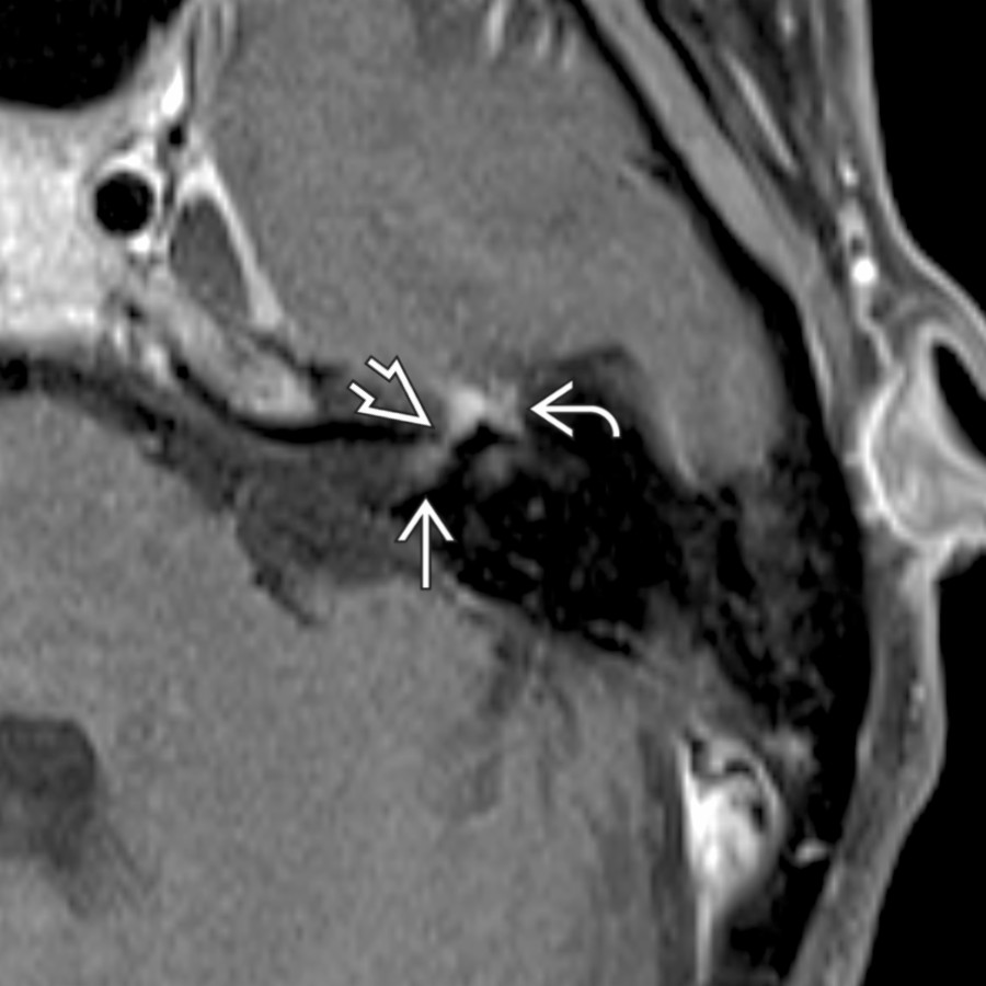 Axial T1 C+ FS MR in a patient with Bell palsy shows a "tuft" of enhancement at the fundus of the internal auditory canal  as well as abnormal enhancement along the labyrinthine segment  and anterior genu  of facial nerve.