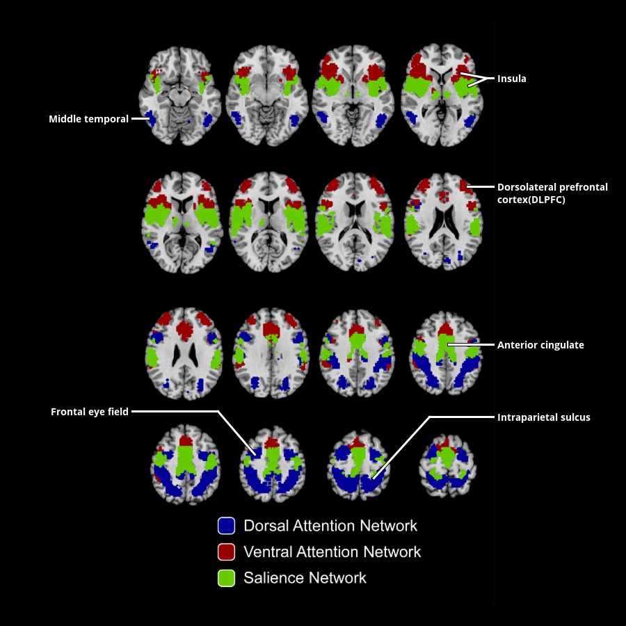 Subnetworks of the attention control network are shown. The mask of attention control network regions was obtained from brain voxels correlated with r > 0.15 to 4 seeds in the bilateral intraparietal sulcus and bilateral superior insula in 1,353 subjects. Functional connectivity was calculated for each voxel within this mask to 7,266 gray matter regions, and voxels were parcellated into 3 clusters using a k-means algorithm based on similar connectivity to the rest of the brain. The voxels in blue show characteristic distribution of the dorsal attention network, including frontal eye fields, intraparietal sulcus, and middle temporal areas. The voxels in green show characteristic distribution of the salience network, including insula and dorsal anterior cingulate areas. The voxels in red show a distribution most consistent with the ventral attention network, including dorsolateral prefrontal, inferior frontal, ventral anterior cingulate, and supramarginal gyrus areas.