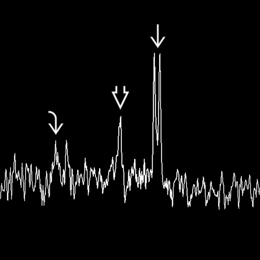 MRS at a long TE in the same patient shows the tumefactive lesion has a depressed choline  and NAA  metabolites in the presence of a large lactate doublet . This MRS helps distinguish this lesion from a neoplasm. MRS of ADEM may show elevated choline acutely.