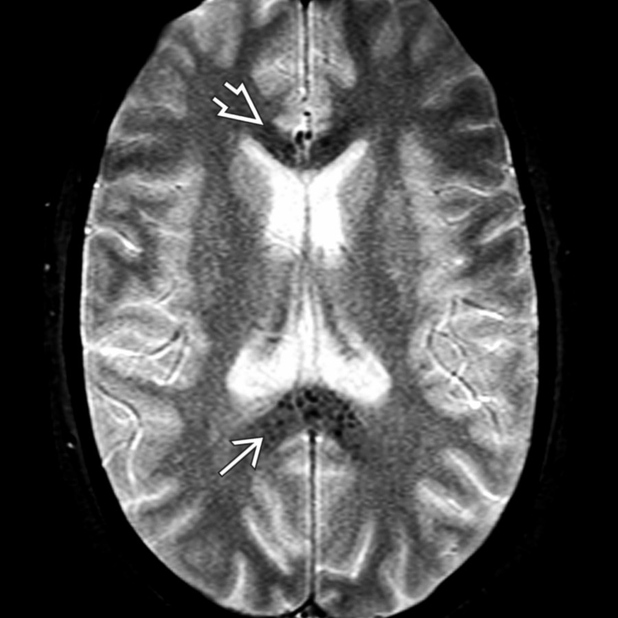 Axial T2* GRE MR in the same patient shows a few punctate "blooming" foci in the corpus callosum genu  and splenium . The remainder of the WM appears normal.