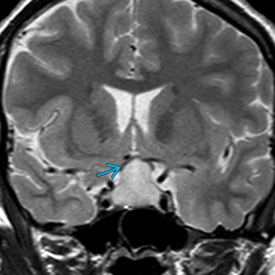 Coronal T2 MR in a pregnant woman with visual changes and endocrine abnormalities shows a hyperintense sellar/suprasellar mass related to LH with superior displacement of the optic chiasm . Imaging mimics pituitary macroadenoma.