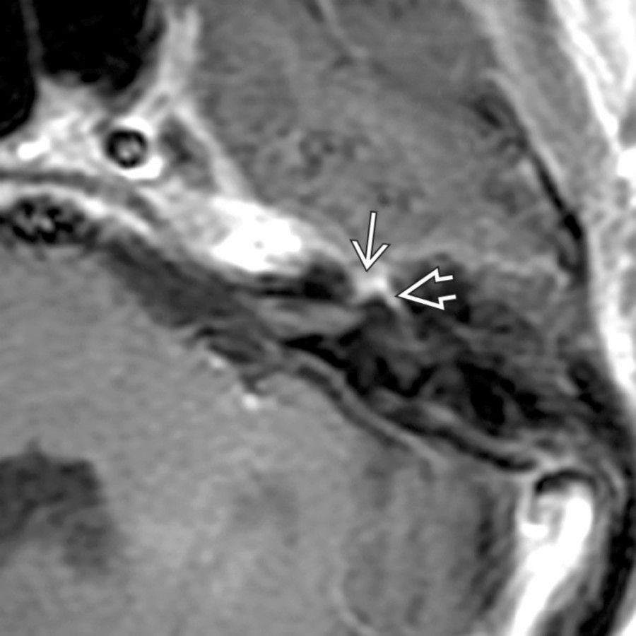 Axial T1 C+ MR reveals prominent but normal enhancement of the geniculate ganglion  and anterior tympanic segment of facial nerve .