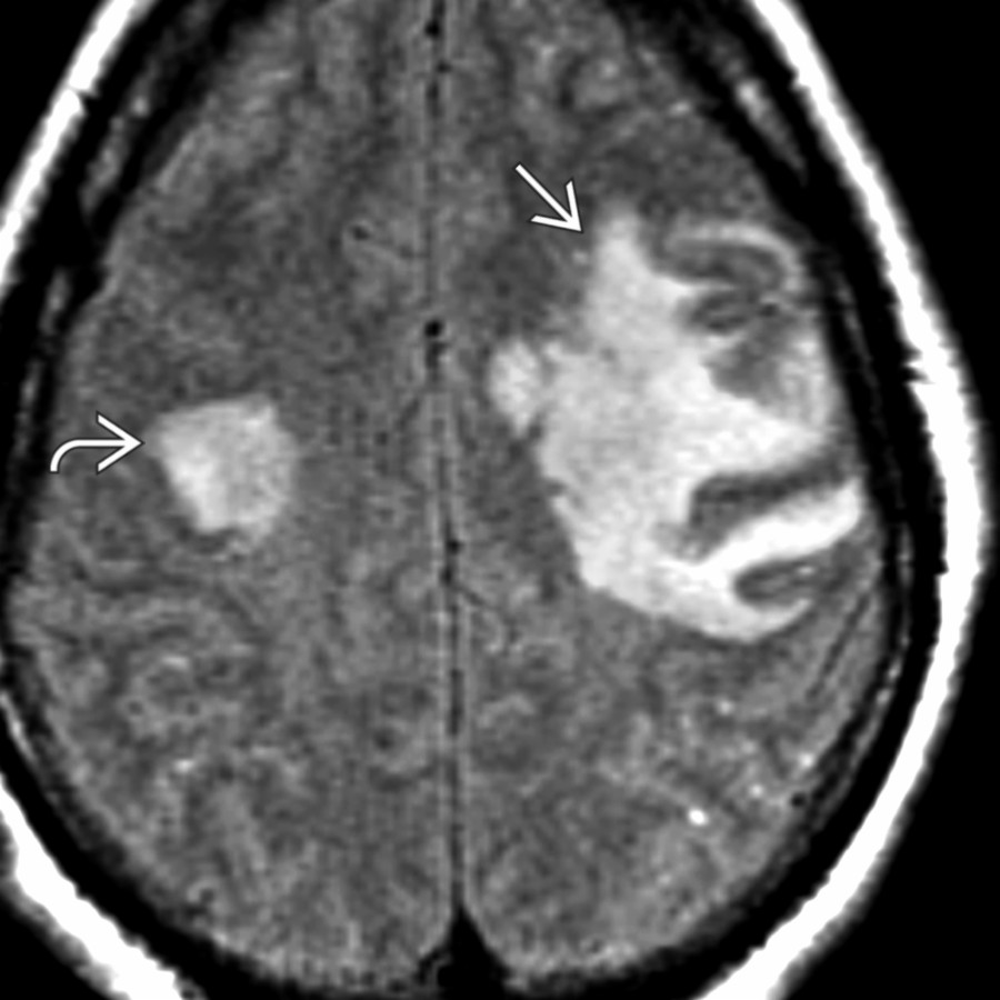 Axial FLAIR MR shows a large, tumefactive, hyperintense ADEM lesion  with mass effect less than expected for the size of the lesion. Another clue to its nonneoplastic nature is the right-sided lesion .