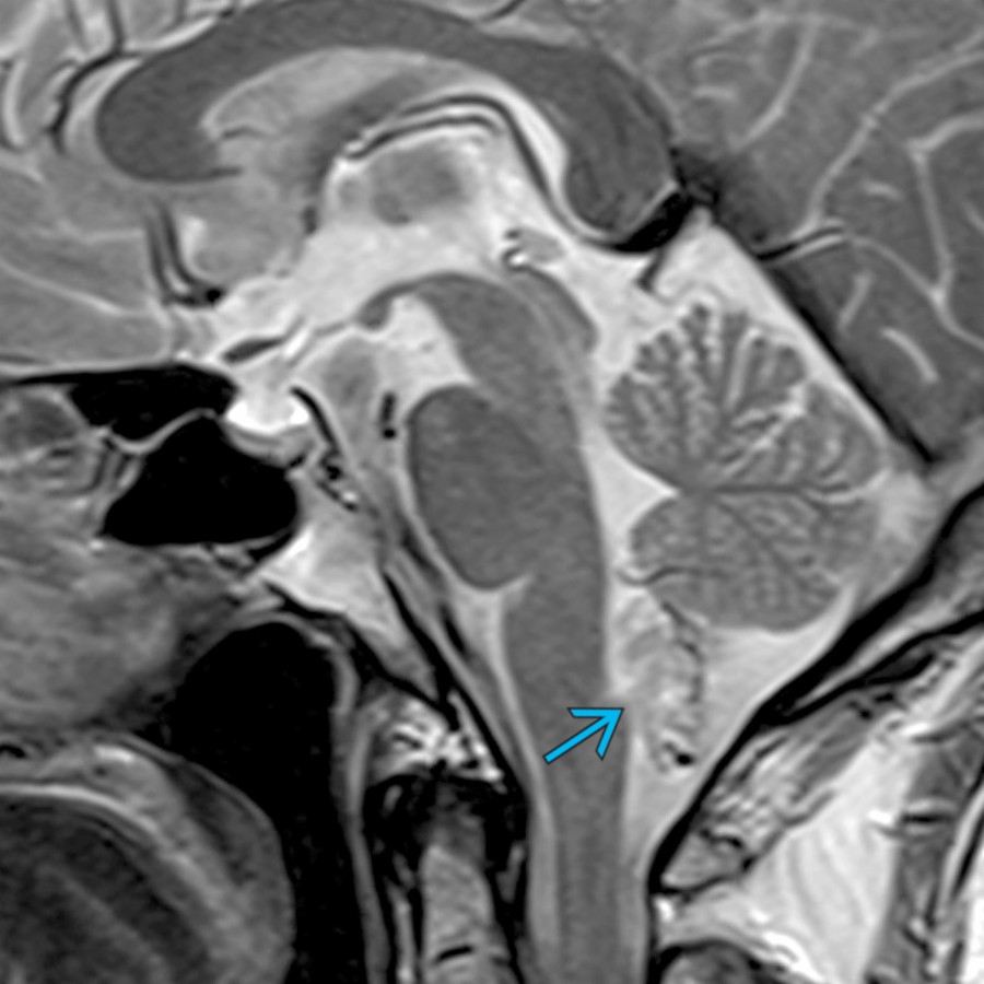 Sagittal T2 MR shows a solid, hyperintense mass along the inferior 4th ventricle  in a 64-year-old man with headaches. A subependymoma was found at resection. These 4th ventricular tumors are often asymptomatic. T2 and FLAIR are typically the most sensitive sequences to identify this WHO grade 1 tumor.