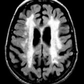 Axial FLAIR MR shows diffuse, confluent white matter hyperintensity in a patient with vascular dementia.