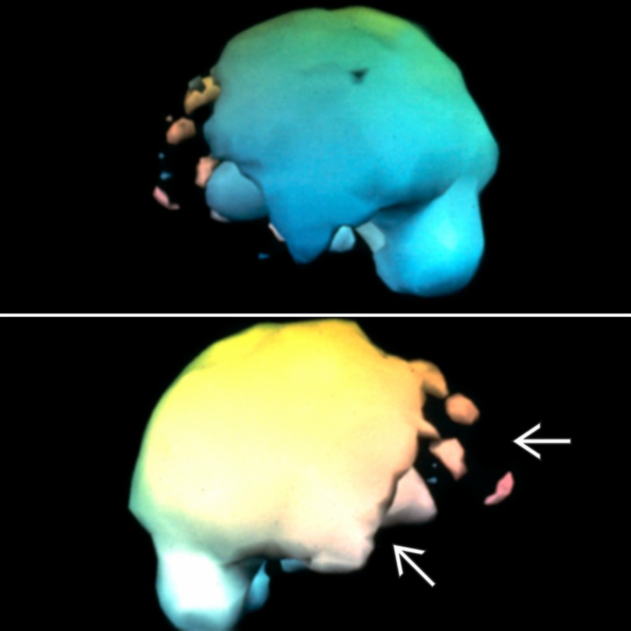 Frontotemporal dementia (FTD) is shown. Note the frontal and anterior temporal reductions  and sparing of parietal, posterior temporal, and occipital regions.
