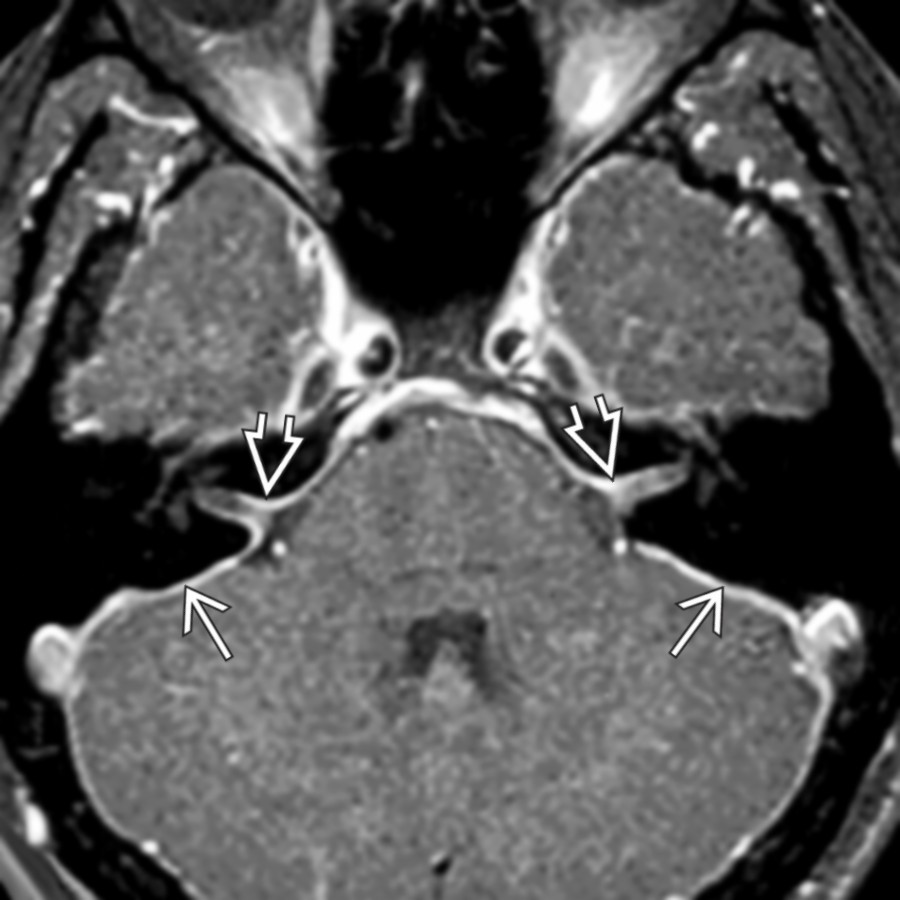 Axial T1WI C+ FS MR in a patient with spontaneous IH shows diffuse dura-arachnoid thickening  from venous engorgement. Note extension into cerebellopontine angles  .
