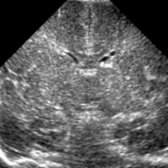 Coronal ultrasound in a 1-day-old premature infant shows a CSF-like intra- or periventricular cyst  with a tiny strand of tissue    that connects the walls of anterior horn.