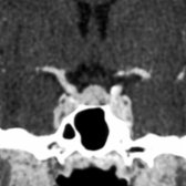 Coronal CECT shows diffuse enlargement and enhancement of the pituitary gland with a convex margin in this 42 year old with ovarian failure.