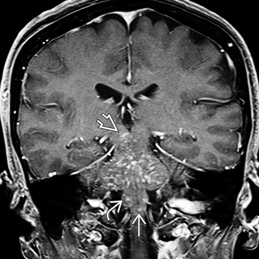 Coronal T1 C+ FS MR in the same patient shows the lesions "peppering" the pons. Note cephalad extension into the cerebral peduncles  and inferior extension into the medulla  and upper cervical cord . DSA (not shown) was negative. The lesions resolved with corticosteroids, so this is a presumed case of CLIPPERS.