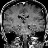 Coronal T1 C+ FS MR in the same patient shows the lesions "peppering" the pons. Note cephalad extension into the cerebral peduncles  and inferior extension into the medulla  and upper cervical cord . DSA (not shown) was negative. The lesions resolved with corticosteroids, so this is a presumed case of CLIPPERS.