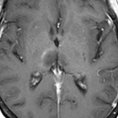 Axial T1 C+ MR in the same patient shows subtle rim enhancement in the lesion in the right thalamus . Brain lesions in NMO/NMOSD are typically localized in the periependymal regions where AQP4 is highly expressed.