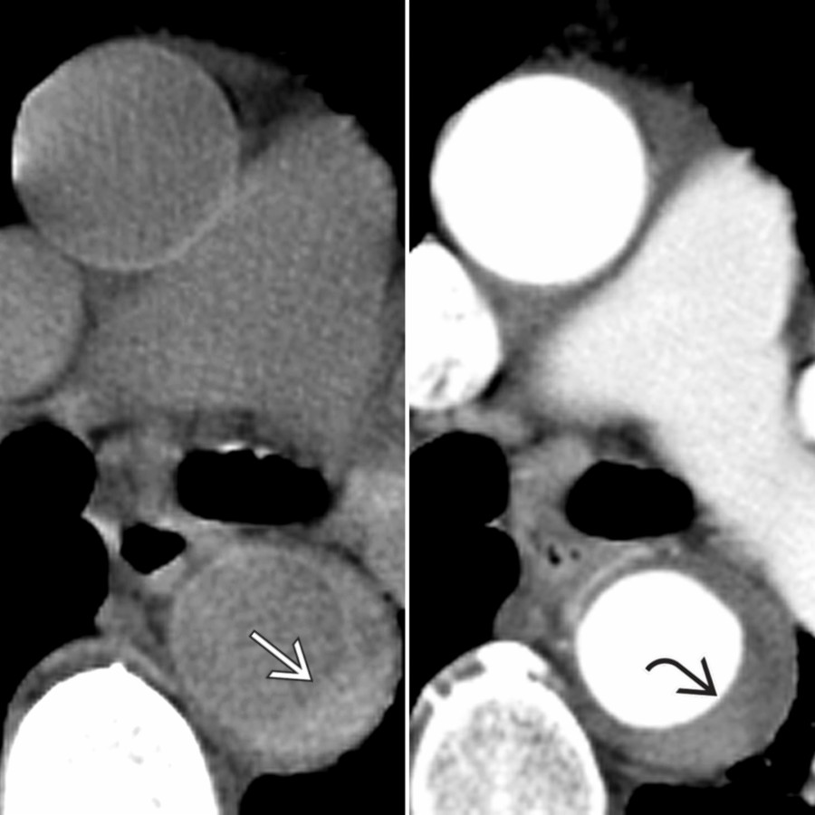 Axial chest NECT in a patient with type B IMH treated clinically shows the classic crescentic aortic wall hyperdensity . CTA demonstrates the classic crescentic  wall thickening .
