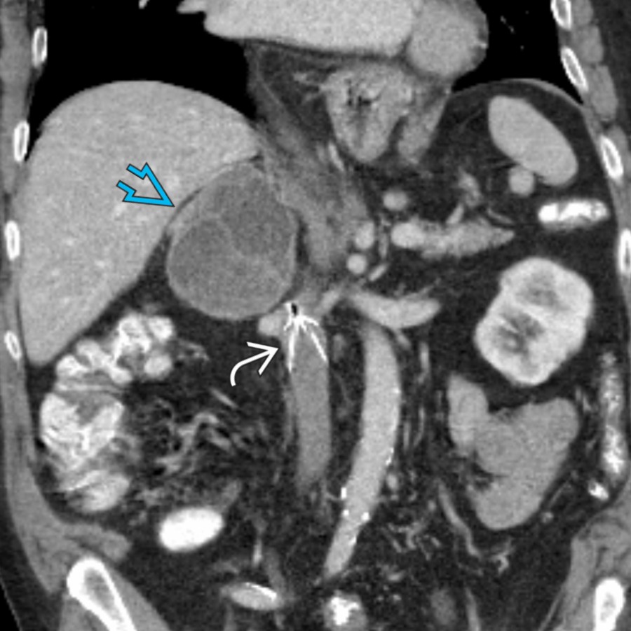 Coronal CECT in a 74-year-old man with neurofibromatosis type 1 (NF1) shows a 10-cm, cystic and solid right adrenal mass , surgically proven to be a pheochromocytoma. ~ 1-6% of patients with NF1 develop pheochromocytoma. Note IVC filter .
