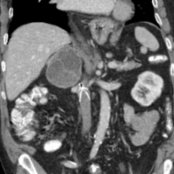 Coronal CECT in a 74-year-old man with neurofibromatosis type 1 (NF1) shows a 10-cm, cystic and solid right adrenal mass , surgically proven to be a pheochromocytoma. ~ 1-6% of patients with NF1 develop pheochromocytoma. Note IVC filter .