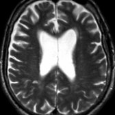 Axial T2WI MR in an 82-year-old woman with clinical vascular dementia shows age-appropriate sulcal prominence, enlarged ventricles, and a focal right parietal lacunar infarct .