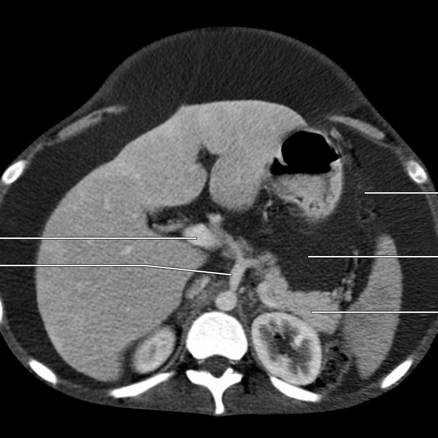 The lesser and greater sacs of the peritoneal cavity are distended with ascites. The gastrosplenic ligament and pancreas border the lesser sac, as does the lesser omentum, whose position is marked by the portal vein and celiac trunk.