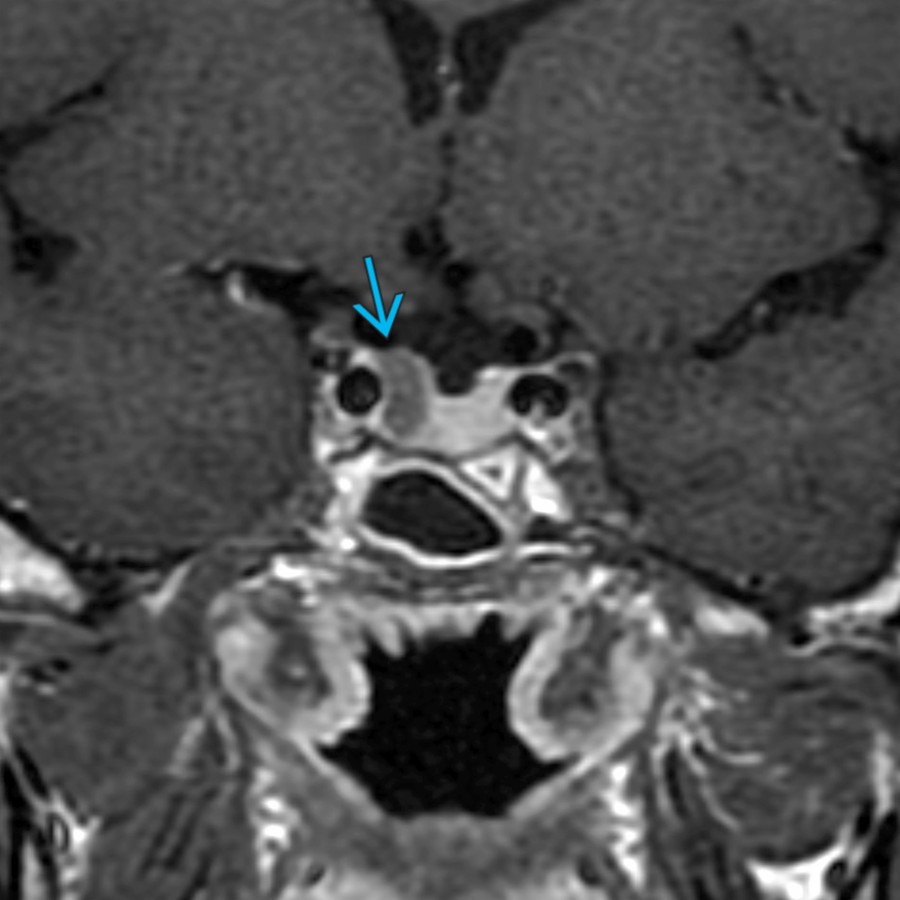 Coronal T1 C+ MR shows a hypoenhancing nodule  in the pituitary gland related to a growth hormone secreting microadenoma in this patient with acromegaly. Prolactinomas are the most common secreting pituitary adenoma.