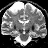 Coronal T2WI MR in the same individual shows hypointense putamina & normal hippocampal size despite loss of brain cortex.