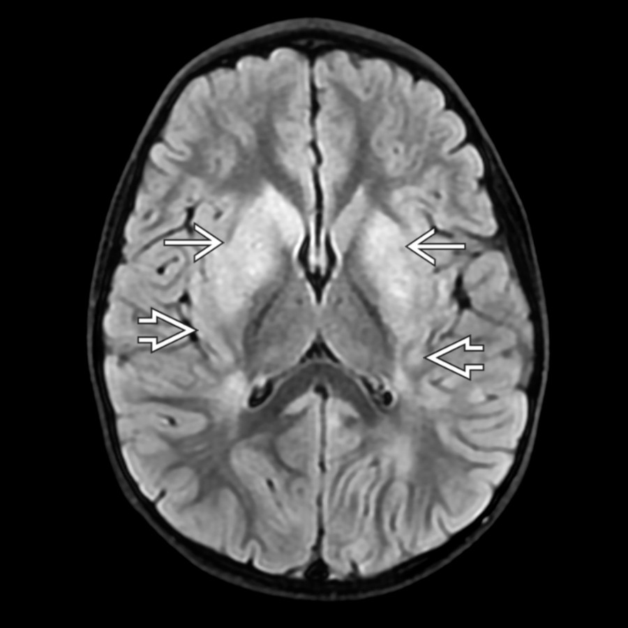 Axial FLAIR MR in a 4-year-old with florid optic neuritis and encephalopathy with positive anti-MOG antibody titer reveals abnormal hyperintensity and swelling within the bilateral basal ganglia , insular cortex , perventricular white matter, and posterior thalami.