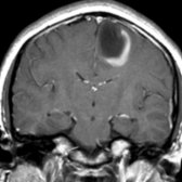 Coronal T1WI C+ MR shows a hypointense mass in the left posterior frontal region with a peripheral crescent of incomplete or "horseshoe" enhancement . This enhancement pattern is classic for tumefactive demyelinating disease, most commonly MS.