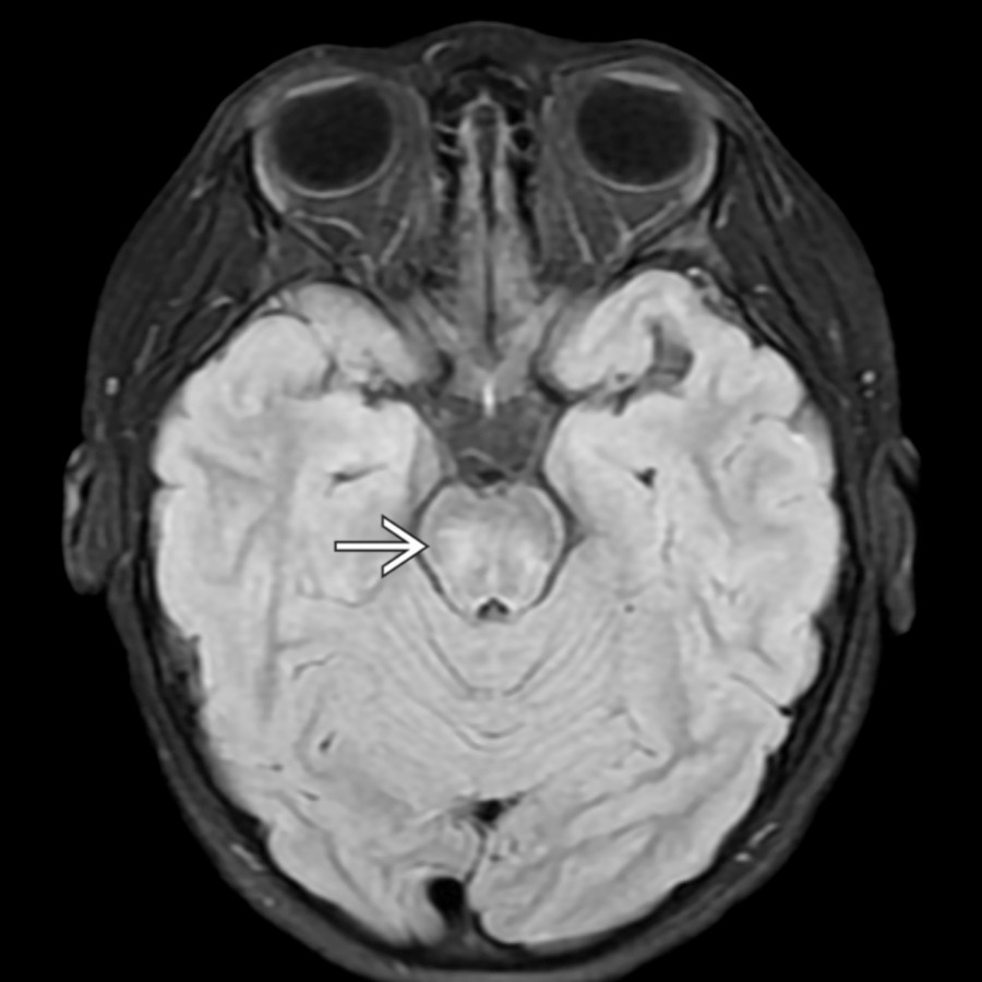 Axial FLAIR MR in the same patient confirms patchy brainstem signal abnormality  as well. This patient also presented with severe transverse myelopathy with longitudinally extensive transverse myelitis (LETM) pattern on spine MR (not shown).
