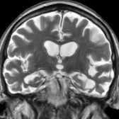 Coronal T2WI MR of a 55-year-old woman with nfv-PPA shows diffuse brain parenchymal atrophy, which is more pronounced in the left perisylvian region  due to atrophy of adjacent inferior & lateral temporal convexity  and frontal operculum .
