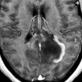 Axial T1WI C+ MR shows irregular, thick, partial ring enhancement around a mass-like lesion in a patient not previously diagnosed with MS. This was biopsy-proven tumefactive MS. (Courtesy M. Mirfakharee, MD.)