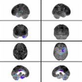Brain surface rendering of F-18 FDG PET of the brain in a patient with svPPA demonstrates statistically significant areas of hypometabolism  within the left anterior temporal lobe relative to an age-matched database.