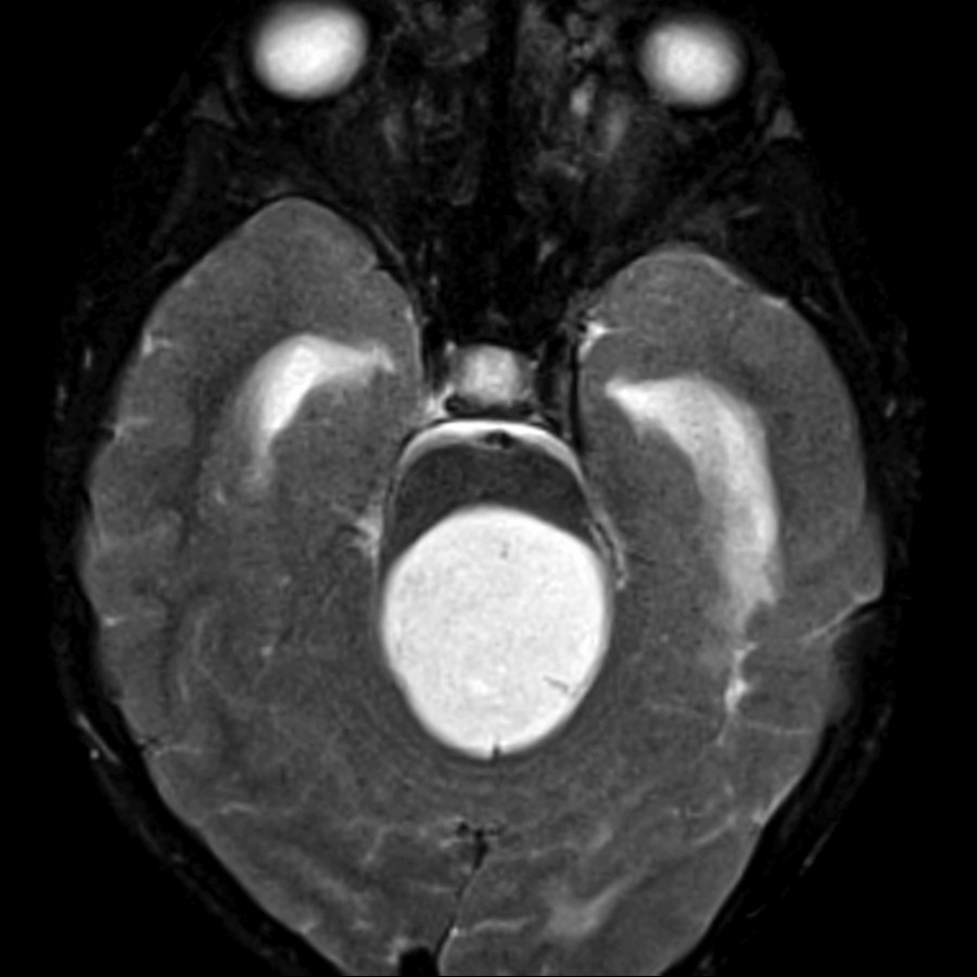 Axial T2 FS MR shows a T2-hyperintense solid mass filling the 4th ventricle. Postcontrast enhancement was seen (not shown), consistent with pilocytic astrocytoma. Low-grade tumors typically have a T2-hyperintense signal of the tumor parenchyma.