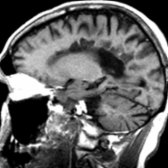 Sagittal T1WI MR shows multiple hypointense lesions ("black holes") in the deep WM   related to axonal destruction. Note the associated moderate ventricular and sulcal enlargement.