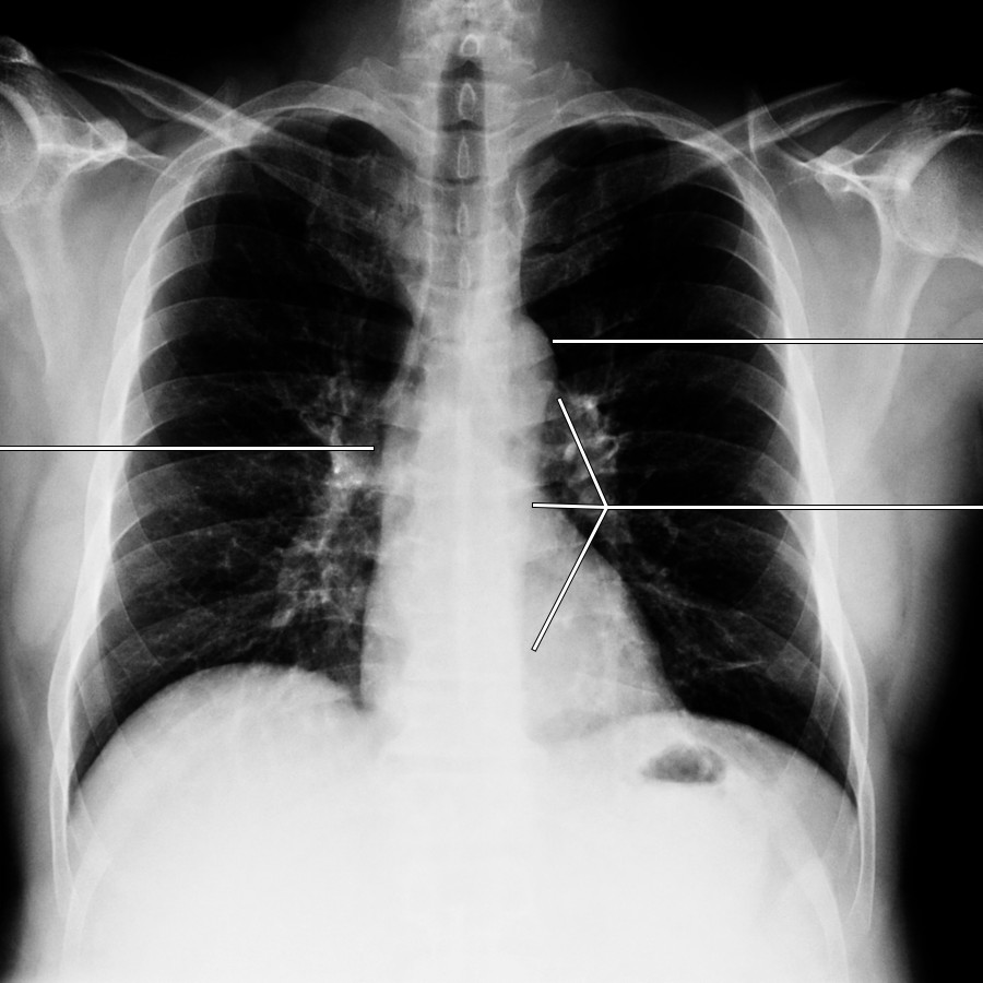Frontal chest radiograph shows a normal thoracic aorta. The aortic knob shadow is created by a superimposition of the aortic arch and proximal descending aorta. The lateral margin of the descending thoracic aorta should always be visible, but the medial margin is usually not perceptible. The lateral margin of the ascending aorta is visible as part of the right mediastinal border.