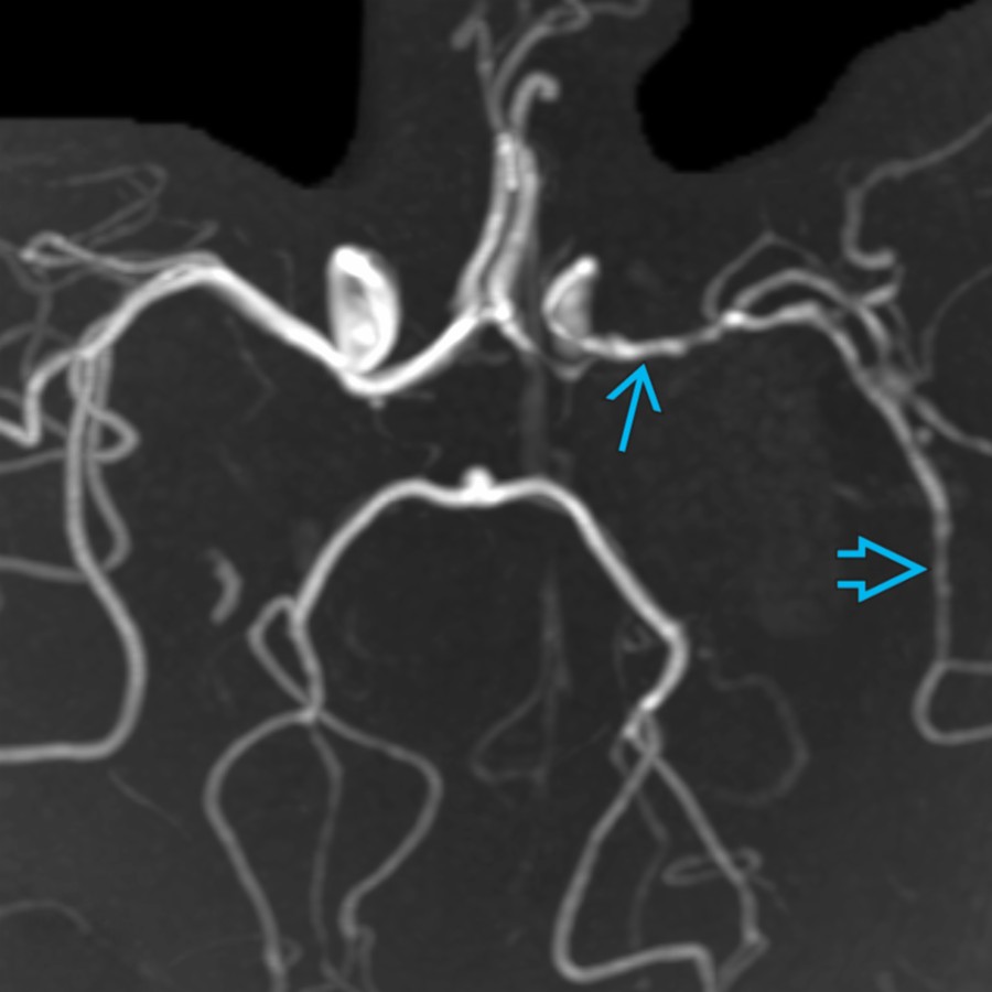 3D MRA of the circle of Willis in the same patient shows irregular narrowing of the left proximal   and distal  segments of the MCA, consistent with vasculitis.