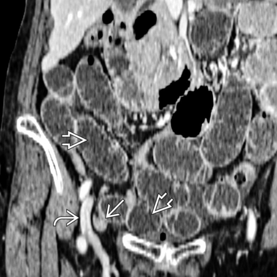 Coronal CECT reformation of a femoral hernia causing small bowel obstruction shows that the neck of the hernia  is medial to the femoral artery . Note the proximal dilation of the small bowel due to obstruction .