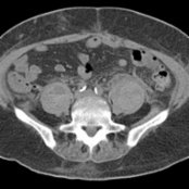 Axial NECT shows enlargement of both psoas muscles due to coagulopathic hemorrhage. Although the hematoma is partly isodense to the muscle, the presence of hematocrit levels  makes the hematomas more apparent. Hematocrit levels suggest coagulopathy as the underlying cause of the bleed.